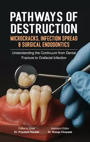 Pathways of Destruction: Microcracks, Infection Spread & Surgical Endodontics Pathways of Destruction: Microcracks, Infection Spread & Surgical Endodontics